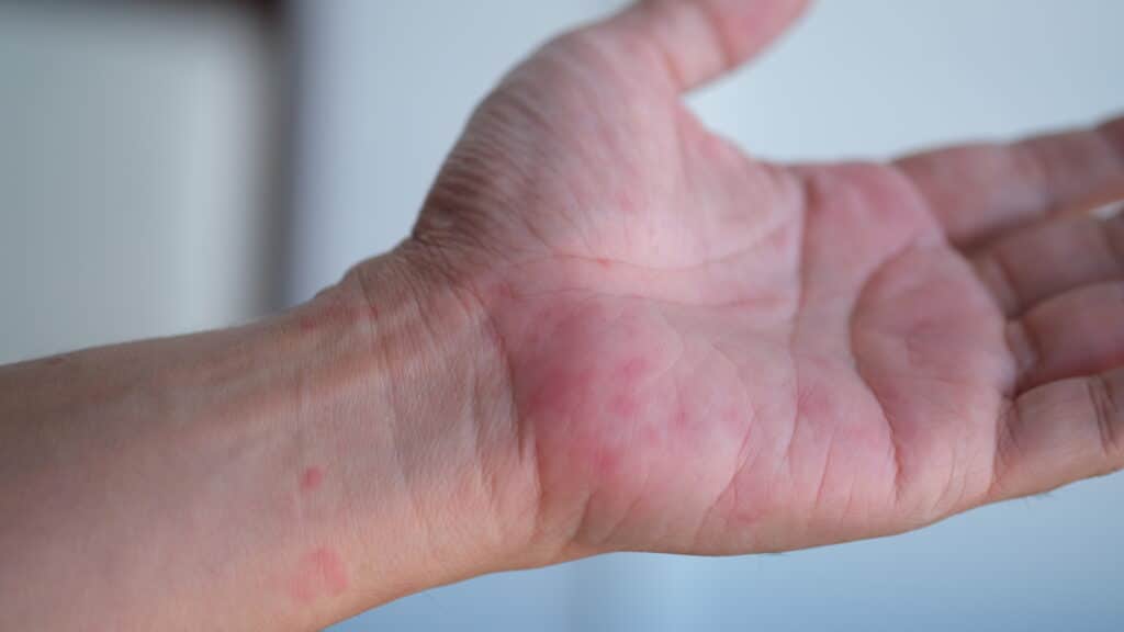 Eine Nahaufnahme einer geöffneten Hand und eines Handgelenks mit roten, gereizten Flecken auf der Haut, die möglicherweise auf einen Ausschlag oder eine allergische Reaktion hinweisen. Der Hintergrund ist unscharf.