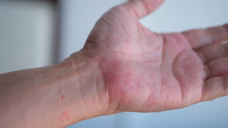 Eine Nahaufnahme einer geöffneten Hand und eines Handgelenks mit roten, gereizten Flecken auf der Haut, die möglicherweise auf einen Ausschlag oder eine allergische Reaktion hinweisen. Der Hintergrund ist unscharf.