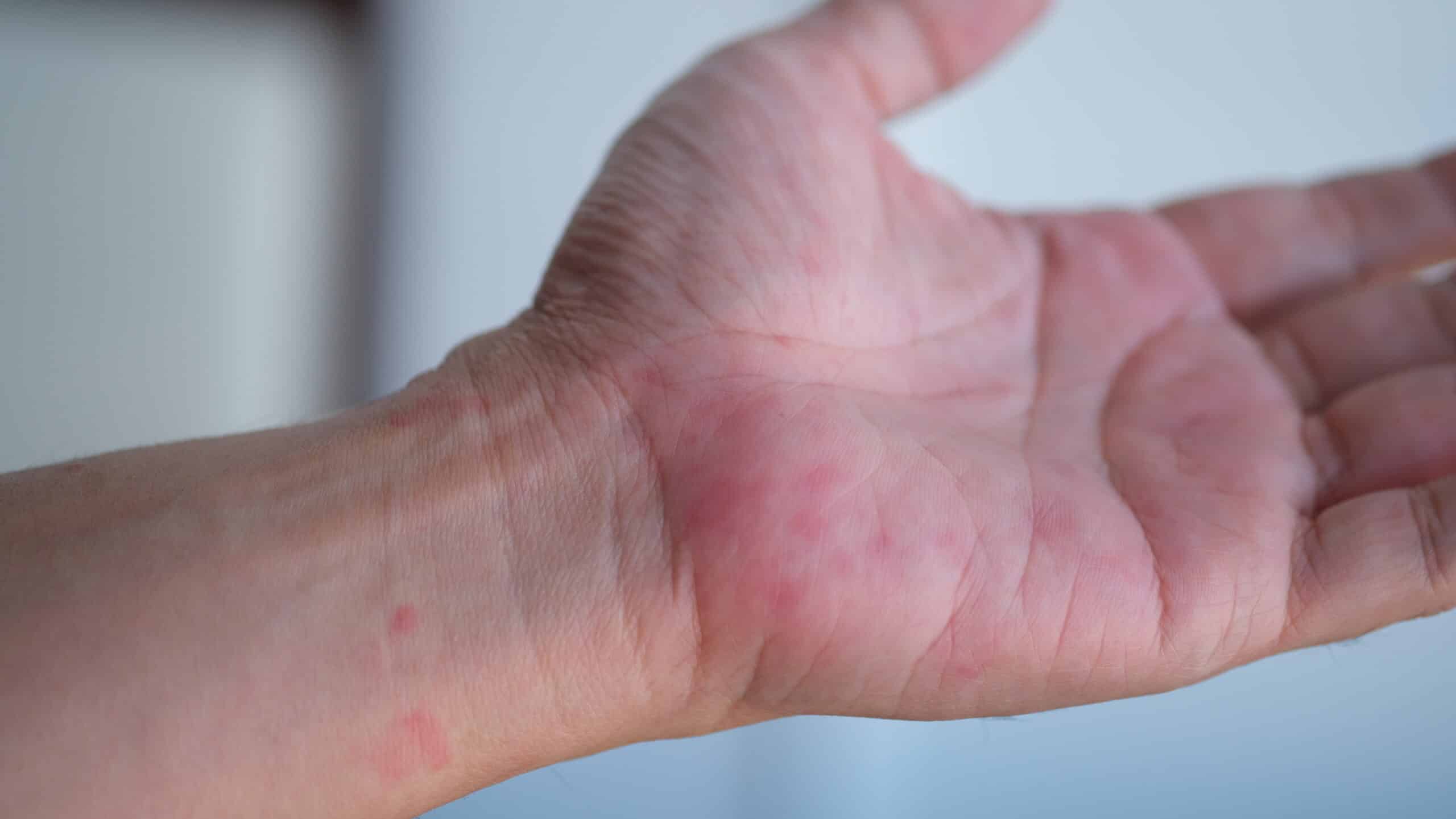 Eine Nahaufnahme einer geöffneten Hand und eines Handgelenks mit roten, gereizten Flecken auf der Haut, die möglicherweise auf einen Ausschlag oder eine allergische Reaktion hinweisen. Der Hintergrund ist unscharf.